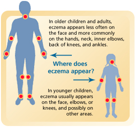 case study of infantile eczema